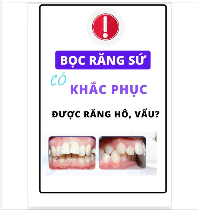 BỌC RĂNG SỨ KHẮC PHỤC ĐƯỢC RĂNG HÔ, RĂNG VẨU KHÔNG?