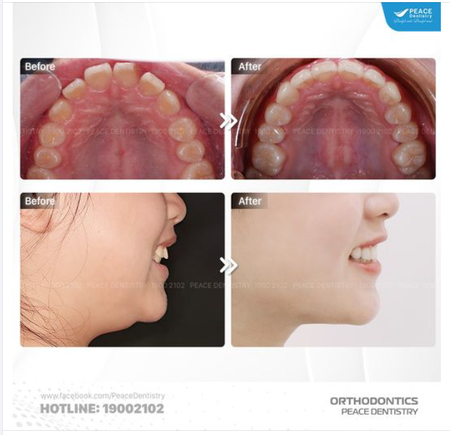 Bạn từng mơ ước về một hàm răng đều đẹp, một nụ cười tự tin? Cô bạn tuổi teen trong hình đã biến ước mơ đó thành hiện thực chỉ sau 20 tháng niềng răng tại Peace Dentistry.