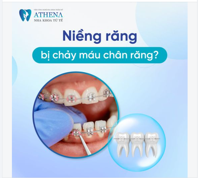 Trong quá trình niềng răng, nhiều người gặp tình trạng chảy máu chân răng, khiến họ lo lắng. Vậy nguyên nhân do đâu và làm thế nào để khắc phục tình trạng này?