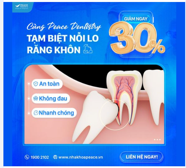 GIẢI QUYẾT RĂNG KHÔN NGAY TRƯỚC KHI QUÁ MUỘN