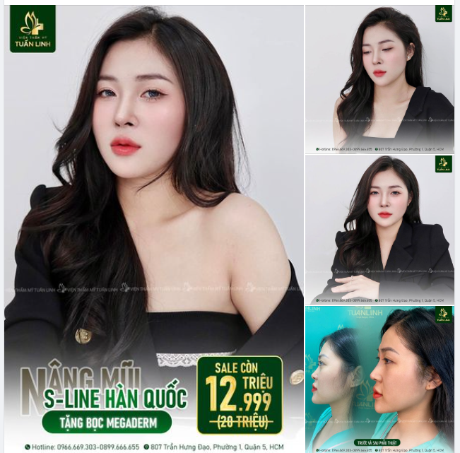 Quà tặng 20/10: Nâng mũi Sline Hàn Quốc tặng bọc Megaderm - Giá Sale còn 12TR999 ( gốc 20 triệu)!!