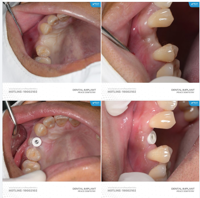 TIÊU XƯƠNG HÀM VÀ GIẢI PHÁP GHÉP XƯƠNG TRONG CẤY GHÉP IMPLANT