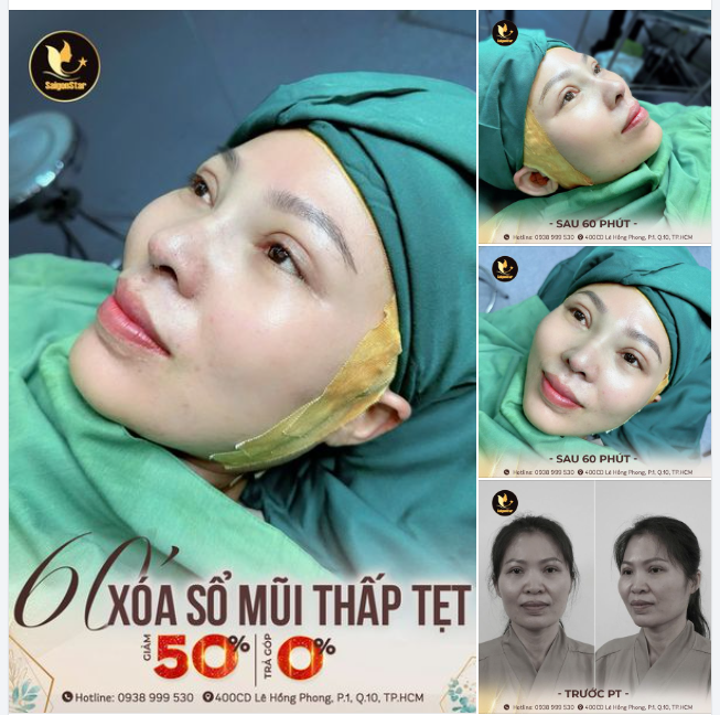 NÂNG MŨI CẤU TRÚC - XÓA BỎ NỖI TỰ TI MŨI THẤP TẸT, TO BÈ CHỈ SAU 60 PHÚT!!!