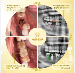 TRỒNG RĂNG IMPLANT - GIẢI PHÁP PHỤC HÌNH RĂNG SÂU VỠ HOÀN HẢO