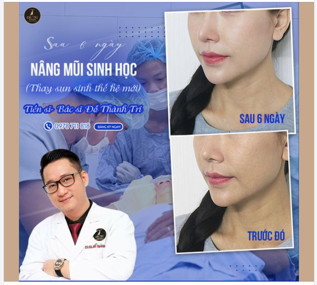 NÂNG MŨI SINH HỌC- Khách từng nâng mũi, mong muốn thay đổi qua chất liệu sinh học thế hệ mới
