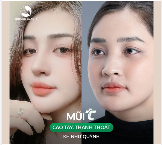 Trước và sau khi khách hàng thực hiện nâng mũi