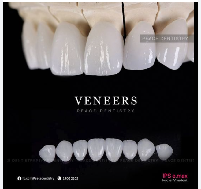 LÀM SỨ VENEER CÓ BỀN HAY DỄ BUNG VỠ & ĂN NHAI CÓ THOẢI MÁI KHÔNG?
