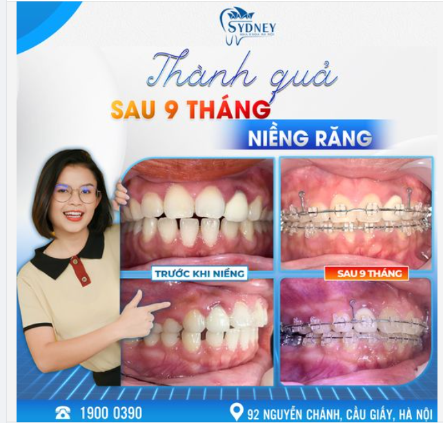 THÀNH QUẢ SAU 9 THÁNG NIỀNG RĂNG MẮC CÀI KIM LOẠI