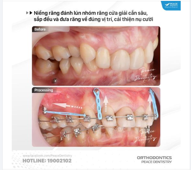 ​​​​​​​ NIỀNG RĂNG KHỚP CẮN SÂU