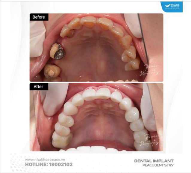 IMPLANT KẾT HỢP RĂNG SỨ CẢI THIỆN ĂN NHAI VÀ THẨM MỸ TOÀN HÀM