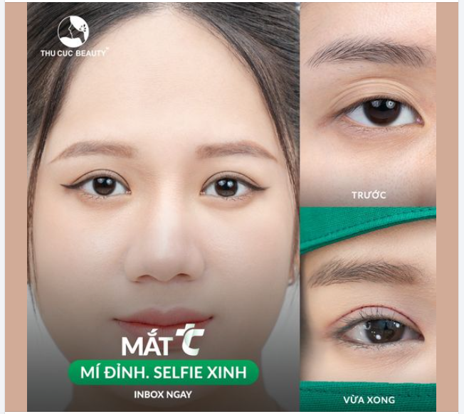  Chiêm ngưỡng nếp mí tự nhiên cùng đôi mắt to tròn của KH sau khi cắt mí
