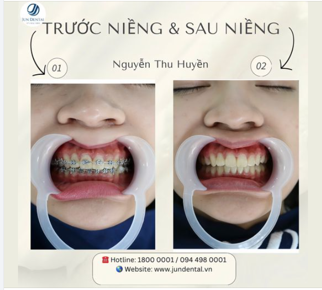 "Từ bé em đã có cái tính ghen tỵ với chị gái em về cái bộ răng đều như bắp của bả nên em đã đặt mục tiêu đầu tiên và nhất định phải thực hiện được khi đi làm là kiếm tiền niềng răng."