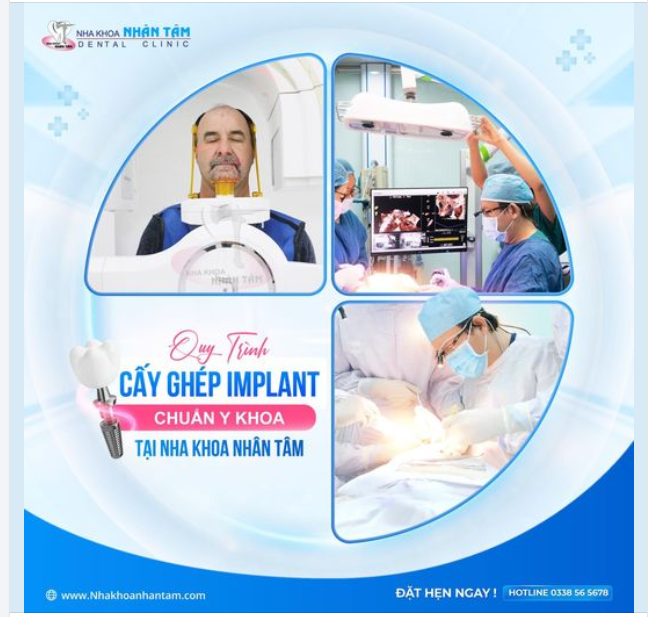 Quy trình cấy ghép implant chuẩn Y khoa tại Nha khoa Nhân Tâm