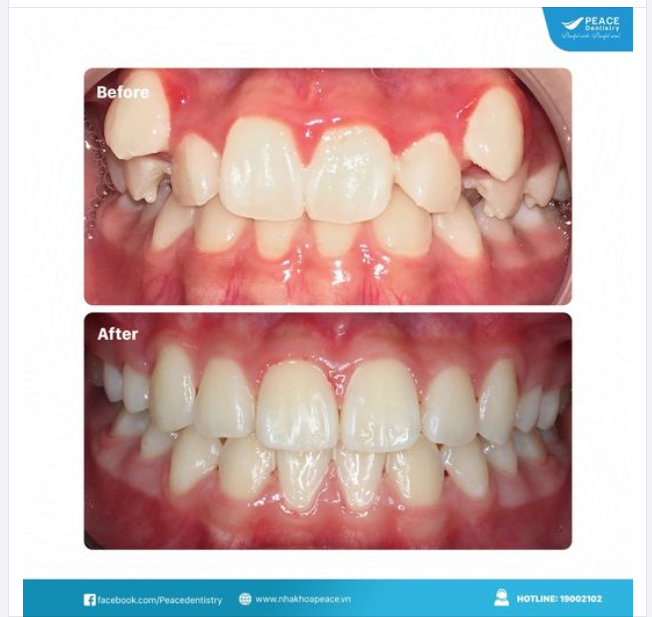 CA LÂM SÀNG niềng răng cho trường hợp răng mọc chen chúc nhiều, khớp cắn hạng I, hẹp 2 hàm