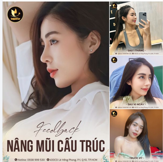FEEDBACK GÓC NGHIÊNG SIÊU NÉT - SAU 10 NGÀY NÂNG MŨI CẤU TRÚC