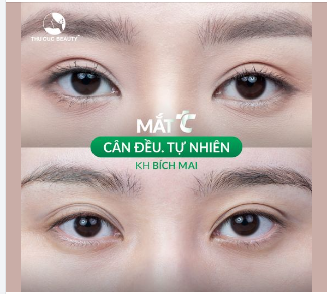Đến TC để khắc phục khuyết điểm đa nếp mí, mí nhiều mỡ sau 15P