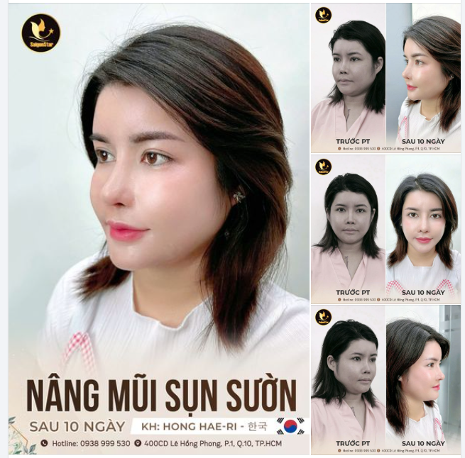 KẾT QUẢ SỬA LẠI MŨI HỎNG SAU 10 NGÀY KH. HONG HAERI (HÀN QUỐC)