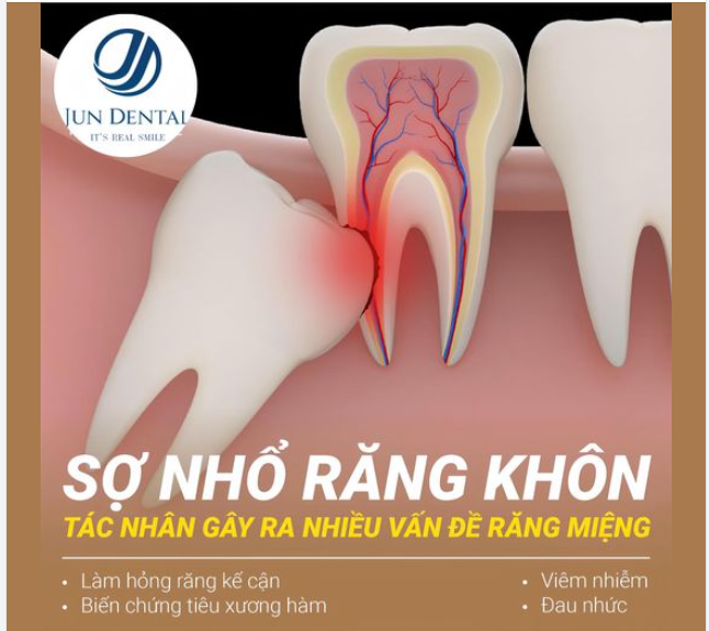 SỢ NHỔ RĂNG KHÔN - TÁC NHÂN GÂY RA NHIỀU VẤN ĐỀ RĂNG MIỆNG
