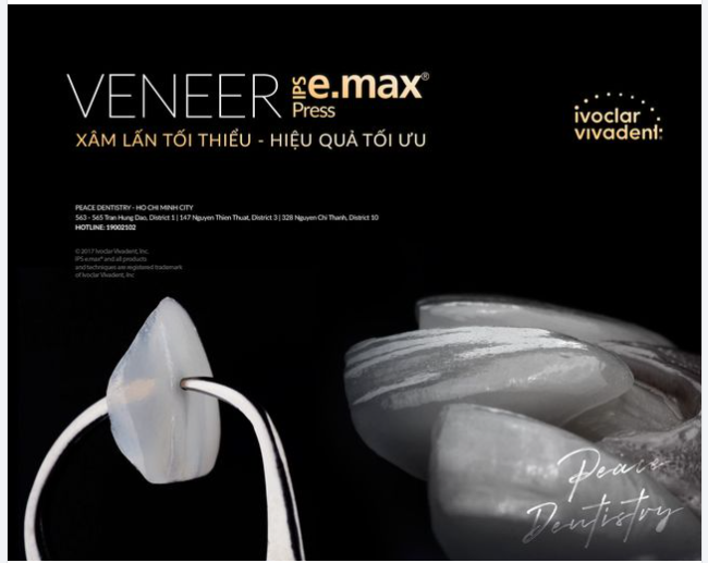 Ý kiến từ 1000 khách hàng đã dán sứ IPS e.max cho thấy, lớp sứ Veneer có khuynh hướng càng trong và bóng hơn theo thời gian.