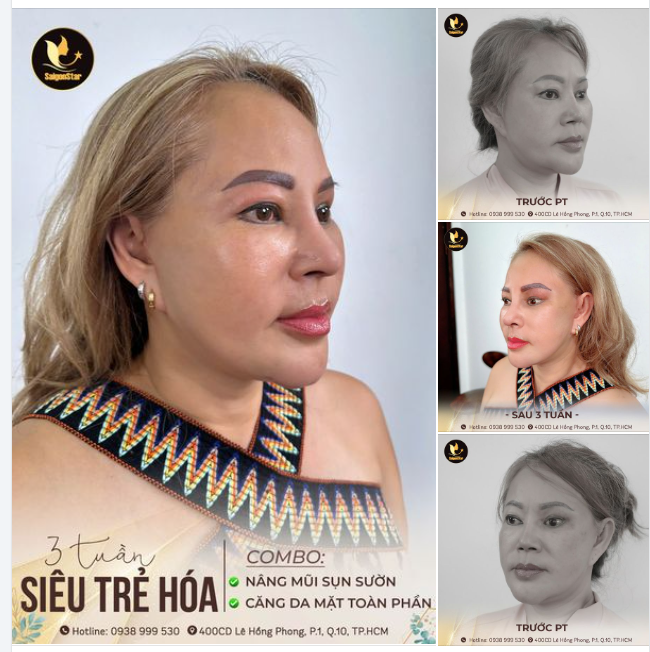 CHỈ MẤT 3 TUẦN TRẺ NGAY 20 TUỔI NÂNG MŨI SỤN SƯỜN - SỬA LẠI MŨI HỎNG CĂNG DA MẶT NỘI SOI - XÓA TAN LÃO HÓA