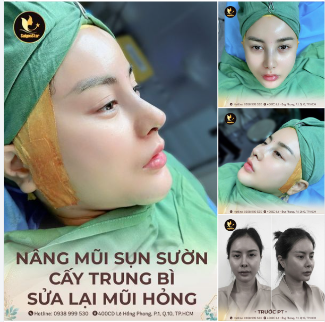 NÂNG MŨI SỤN SƯỜN + CẤY TRUNG BÌ KHẮC PHỤC MŨI HỎNG - TỰ TIN TỎA SÁNG