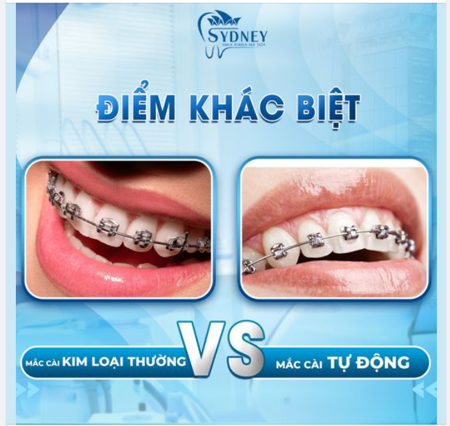 ĐIỂM KHÁC BIỆT CỦA MẮC CÀI KIM LOẠI THƯỜNG VÀ TỰ ĐỘNG