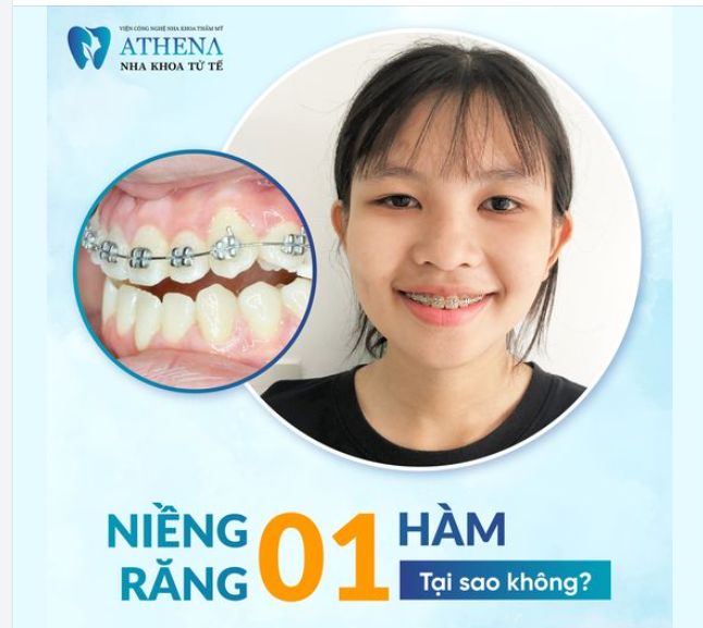 Nhiều người thắc mắc liệu có thể chỉ niềng răng 1 hàm không?