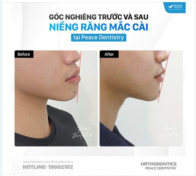 Sự hợp tác giữa bác sĩ và người niềng răng (tuân thủ đúng kế hoạch và hướng dẫn) là rất quan trọng để đạt được kết quả như kỳ vọng và có được những nụ cười tuyệt vời.
