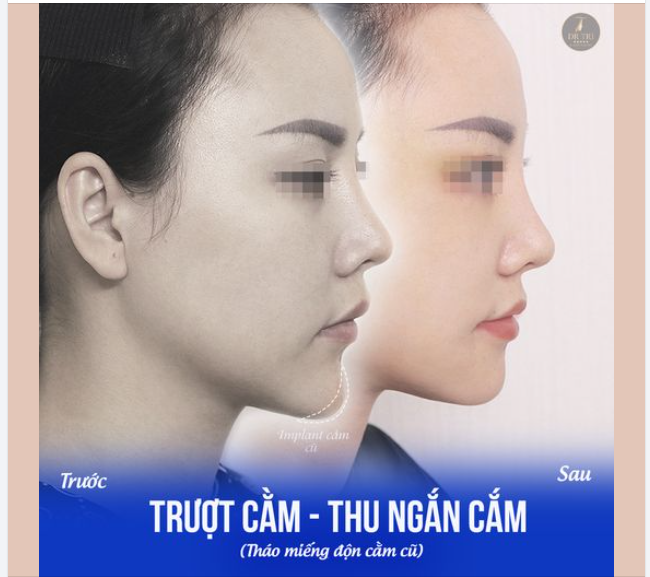 TRƯỢT CẰM V-LINE VĨNH VIỄN