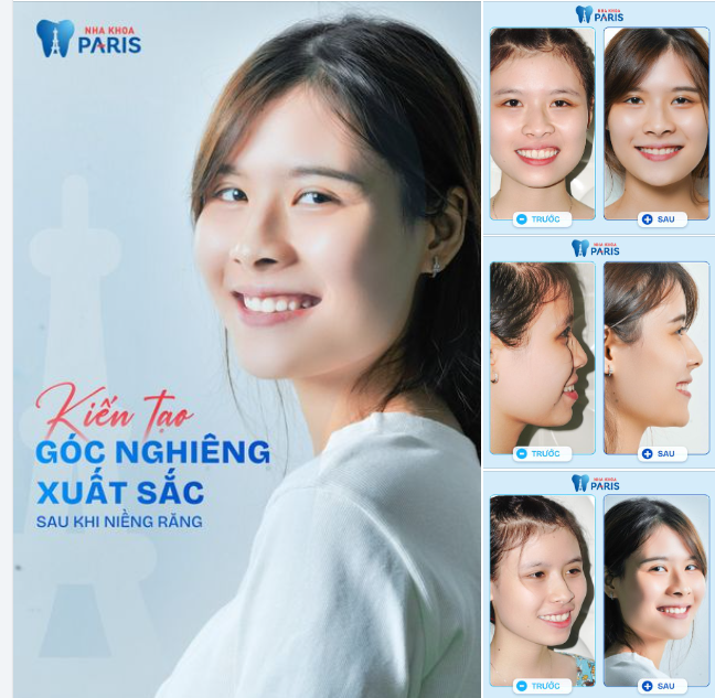Năm 2022, Thảo Vi đến Paris với tâm sự "Góc nghiêng của em không được đẹp, cứ bị tù tù, em cũng thấy bị hơi hô và răng cũng không được đều".