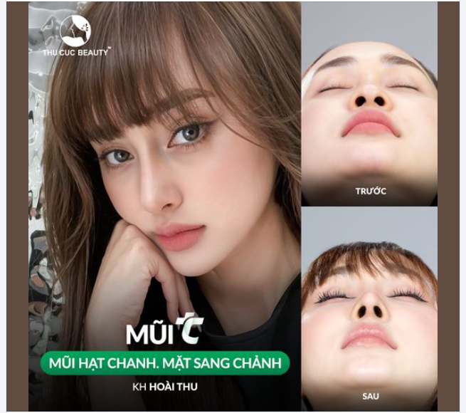 Sống mũi thấp không còn là nỗi lo của chị em Chọn Mũi TC