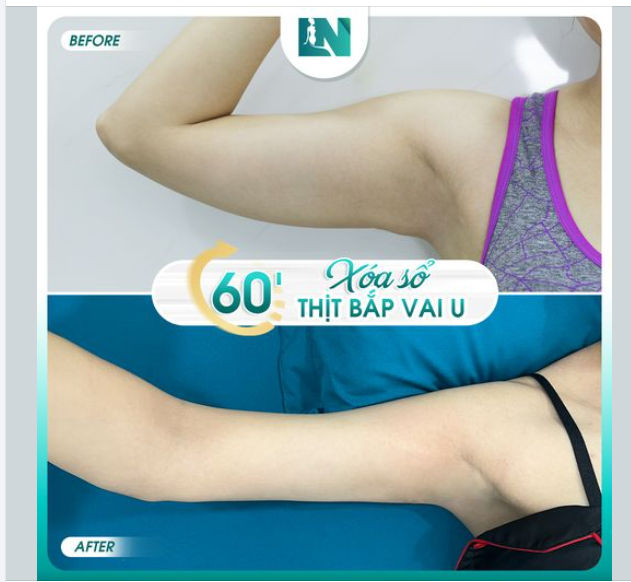 SẠCH MỠ BẮP TAY - THOÁT KIẾP NỮ "TAY ĐÔ"
