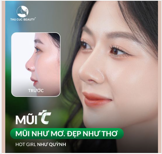 Khắc phục sống mũi thấp hóa cao bay Hot girl Như Quỳnh lựa chọn Mũi TC