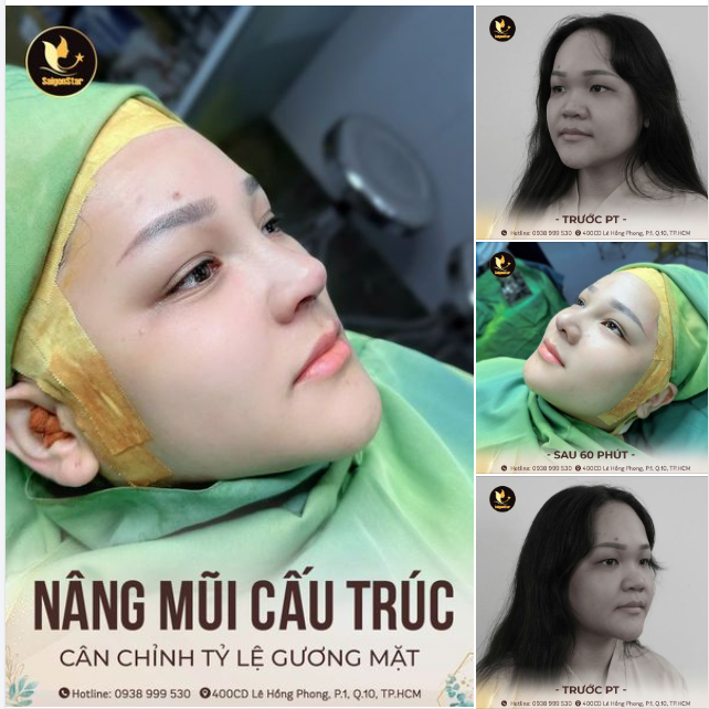 NÂNG MŨI CẤU TRÚC - CÂN CHỈNH TỶ LỆ GƯƠNG MẶT CHỈ VỚI 60 PHÚT