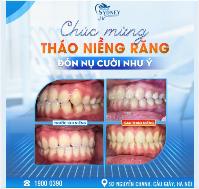 THÁO NIỀNG RĂNG - ĐÓN NỤ CƯỜI NHƯ Ý