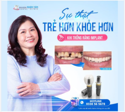 Trẻ hơn, khỏe hơn nhờ cấy ghép implant