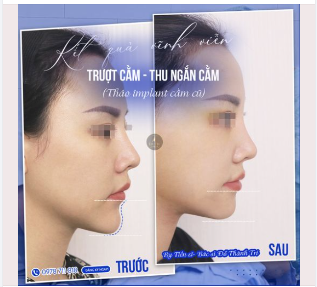 Tiến sĩ Bác sĩ Đỗ Thành Trí - Bác sĩ nổi danh về Trượt cằm V-Line đẹp tại Việt Nam
