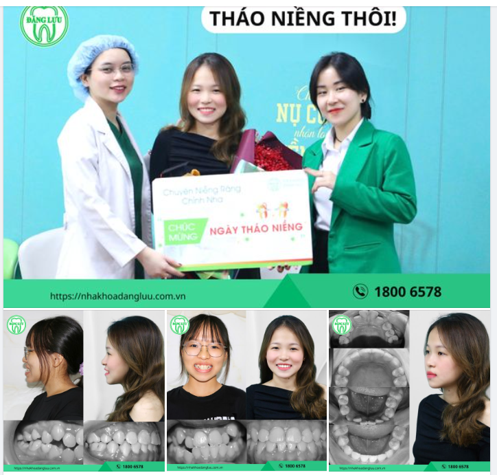 RĂNG XINH RỒI, THÁO NIỀNG THÔI!!!
