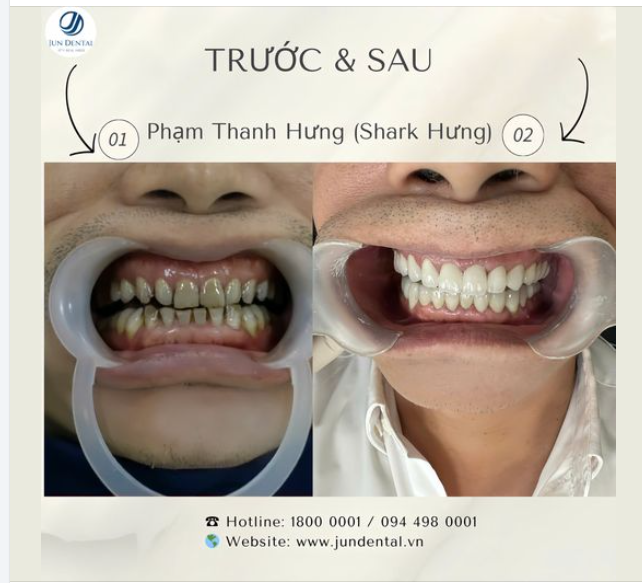 Nha khoa Jundental chào đón Shark Hưng ​​​​​​​ qua tái khám răng sứ thẩm mỹ sau 4 năm làm răng sứ tại Jundental.