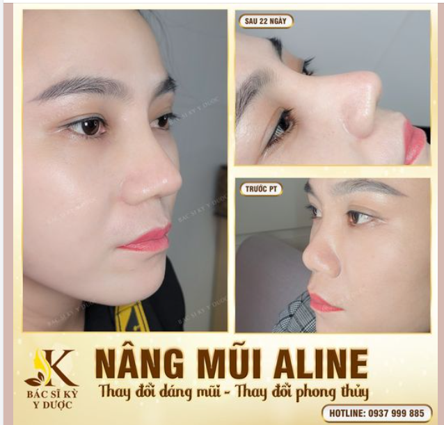 GƯƠNG MẶT “NHẠT NHÒA” VÌ DÁNG MŨI “BẤT LỢI”?