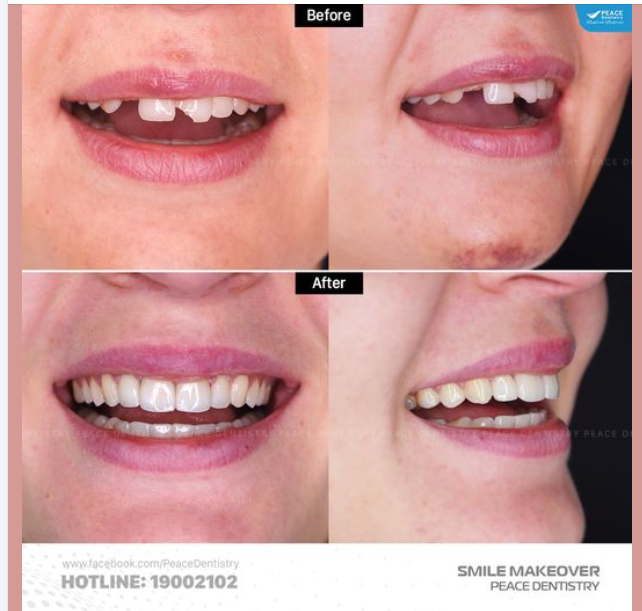 PHỤC HỒI THẨM MỸ SAU TAI NẠN CHẤN THƯƠNG GÃY, MẺ RĂNG