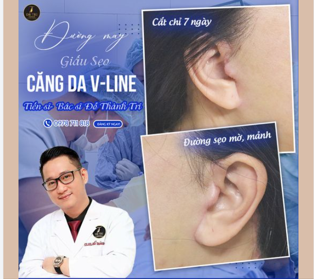 Đường sẹo mảnh "chất lừ" 7 ngày. Dự là mờ dần sau 1-3 tháng tới.