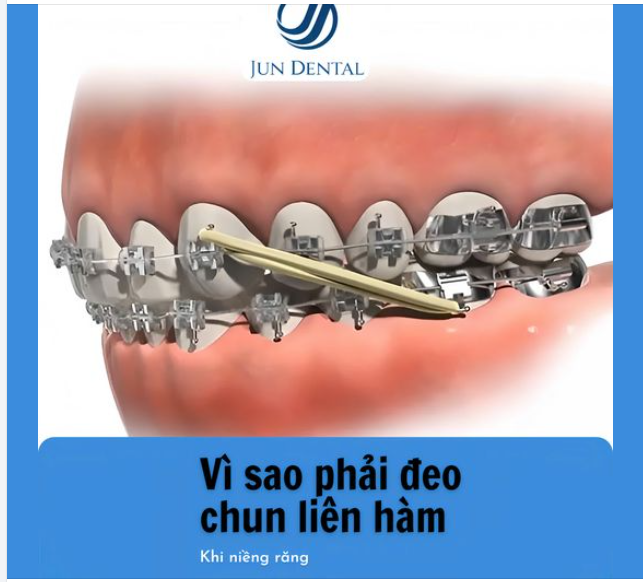 VÌ SAO PHẢI ĐEO CHUN LIÊM HÀM KHI NIỀNG RĂNG ?