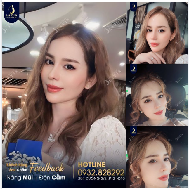 Nhan sắc đỉnh cao sau 4 năm Nâng mũi - Độn cằm