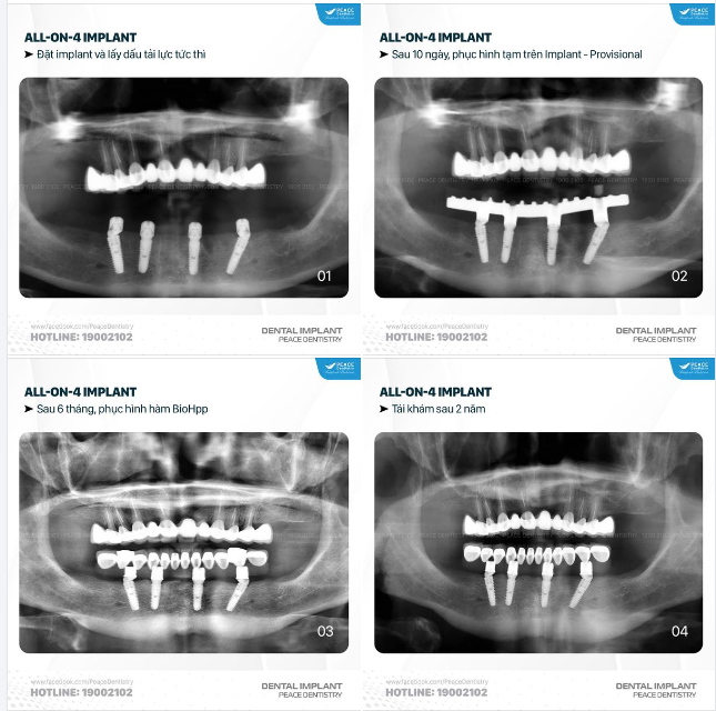 HÌNH ẢNH PHIM PANOREX TIẾN TRÌNH MỘT CA LÂM SÀNG IMPLANT TOÀN HÀM TẠI PEACE DENTISTRY