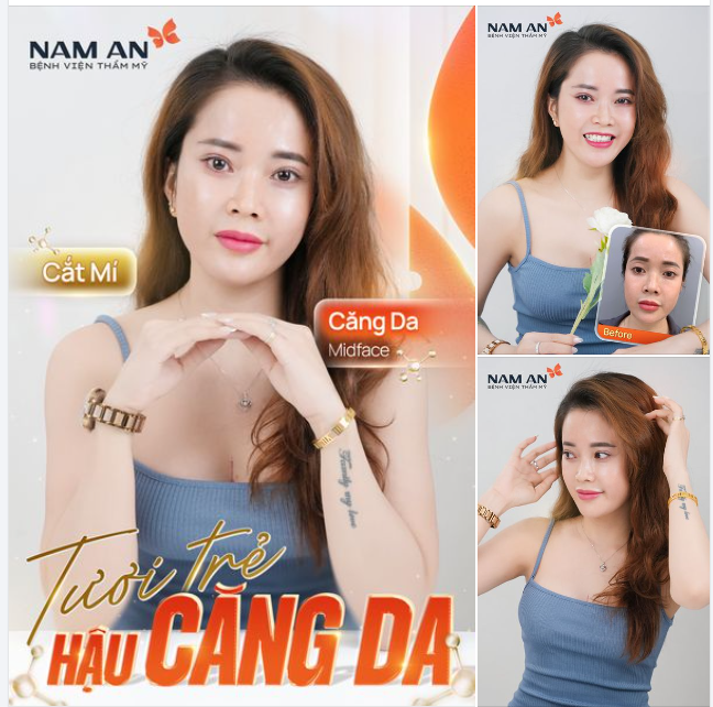 TRẺ TRUNG VÀ RẠNG RỠ SAU CẮT MÍ  CĂNG DA MIDFACE TẠI NAM AN