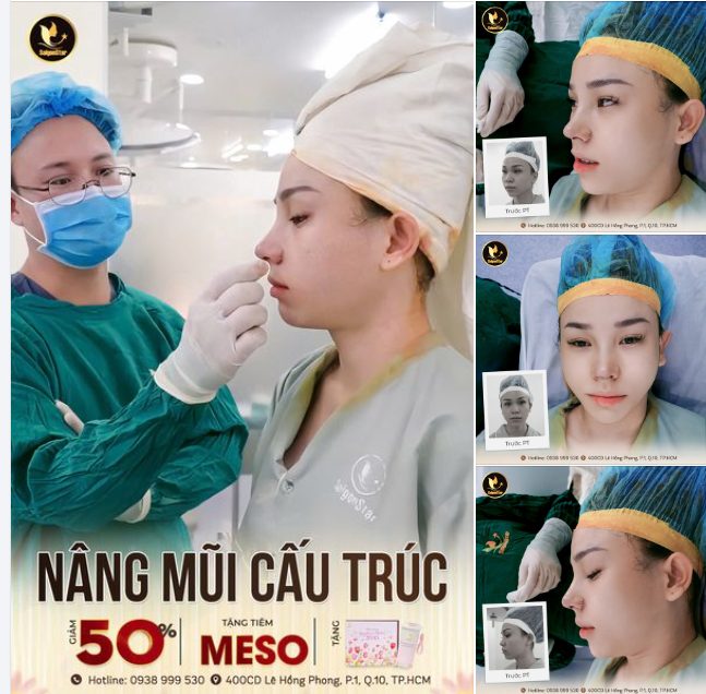 NÂNG MŨI CẤU TRÚC - FORM ĐẸP DÁNG BỀN