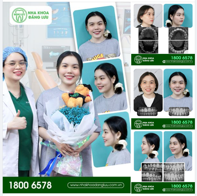RĂNG XINH RỒI, THÁO NIỀNG THÔI!!!