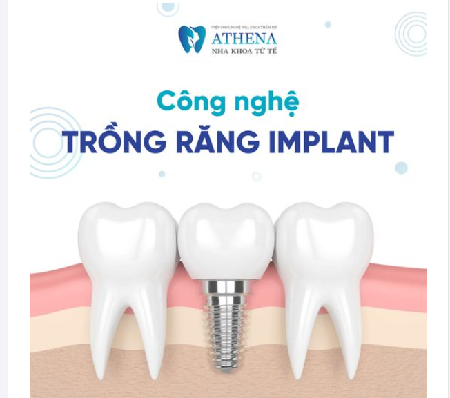 Nếu bạn đang tìm kiếm giải pháp phục hình răng đã mất, trồng răng implant tại Nha Khoa ATHENA là lựa chọn hoàn hảo.