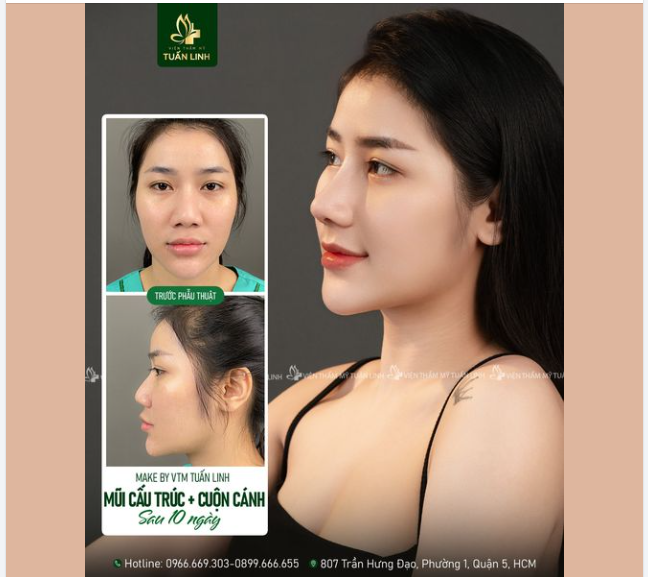 Mũi cấu trúc + cuộn cánh đẹp thanh thoát sau 10 ngày tái khám!!